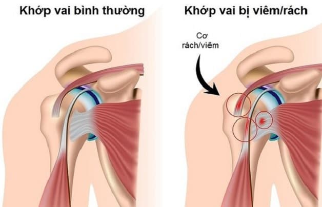 Bệnh viêm chu vai tình trạng khớp vai bị đau nhức gây cản trở hoạt động vùng vai