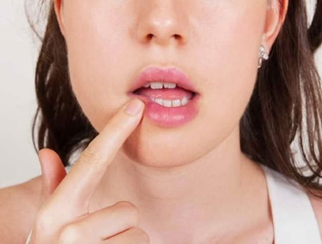 Bị nhiệt miệng nên ăn gì