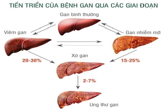 Bệnh lý gan nhiễm mỡ có nguy hiểm không