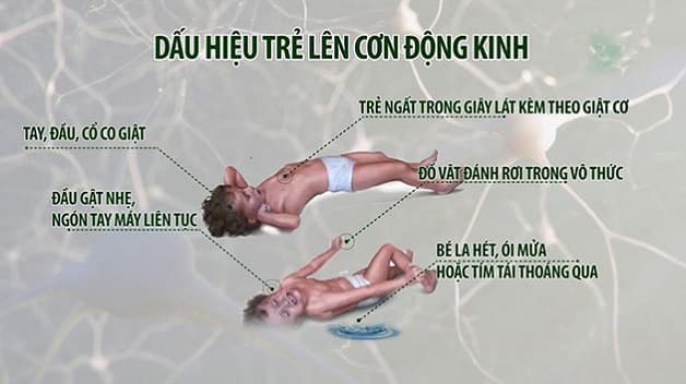 biểu hiện động kinh khi ngủ 