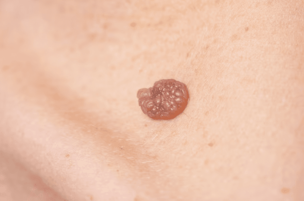 Một số cách nhận biết các bệnh lây qua đường tình dục thường gặp