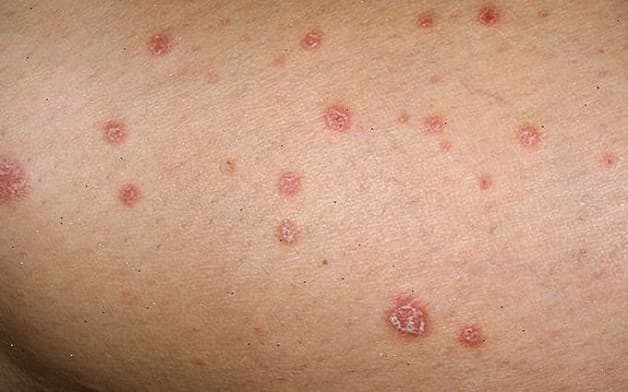 Tìm hiểu các bệnh tình dục nguy hiểm nhất hiện nay