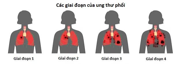 Diễn biến và điều trị ung thư phổi giai đoạn 3