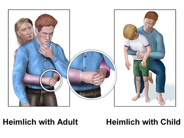 cách chữa hóc xương cá ở cổ