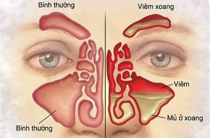 cách chữa viêm xoang mũi hiệu quả