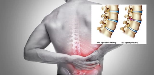 Chuyên gia gợi ý biện pháp cải thiện thoát vị đĩa đệm