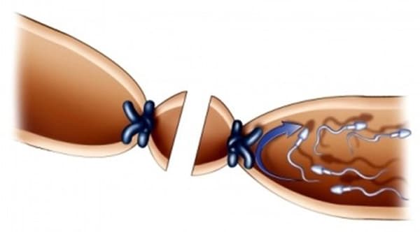 Thắt ống dẫn tinh giúp nam giới kiểm soát gần như 100% khả năng sinh sản của mình