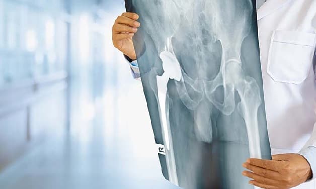 Việc chẩn đoán bệnh thoái hóa khớp háng cần kết hợp giữa các phương pháp lâm sàng và cận lâm sàng