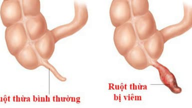 Dấu hiệu của ruột thừa và các thông tin cần biết