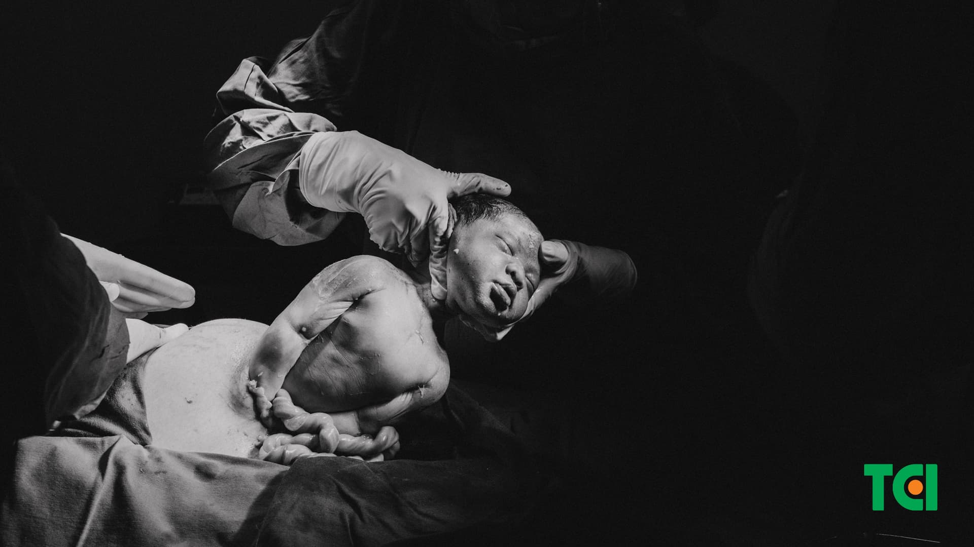 Đẻ mổ là một quá trình phẫu thuật đưa thai nhi ra ngoài thông qua một vết mổ ở phần bụng dưới