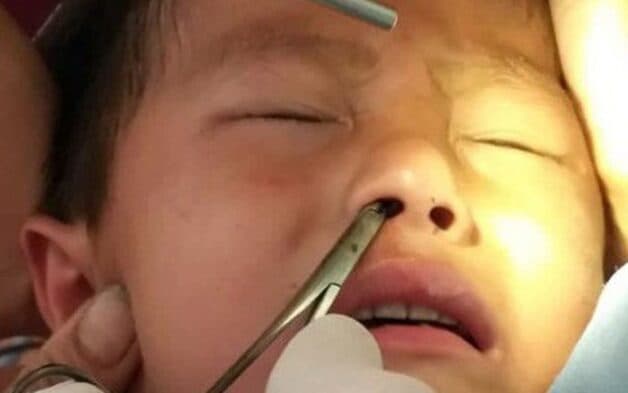 dị vật bay vào mũi