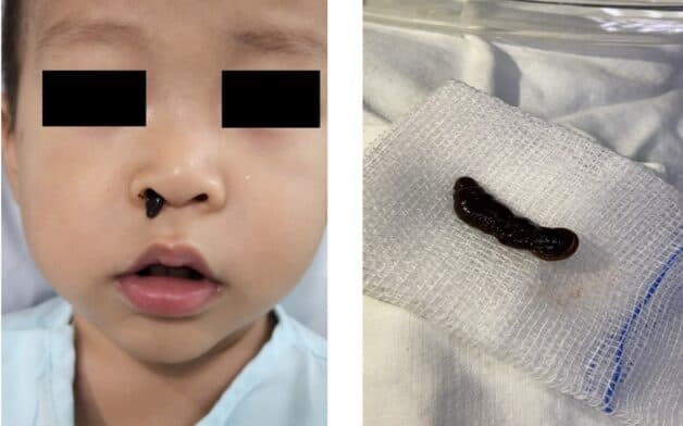 dị vật chui vào mũi trẻ
