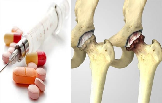Việc sử dụng thuốc chữa thoái hóa khớp háng cần tuân thủ theo đúng chỉ định của bác sĩ
