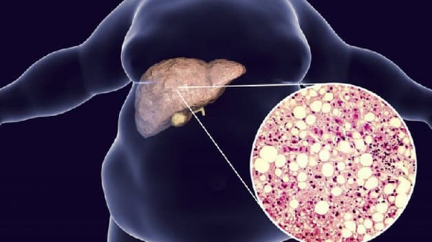 Gan nhiễm mỡ độ 4 là bệnh lý nguy hiểm, thường đi kèm với viêm gan và xơ gan