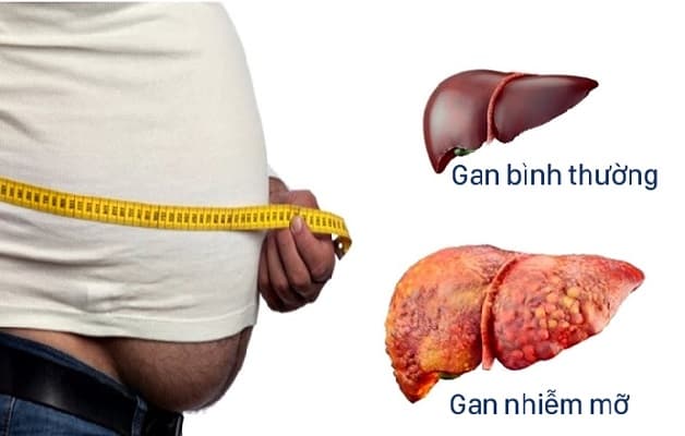 Thừa cân, béo phì là những yếu tố tiềm ẩn gây tích tụ mỡ trong gan