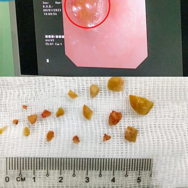 Gắp dị vật trong phổi