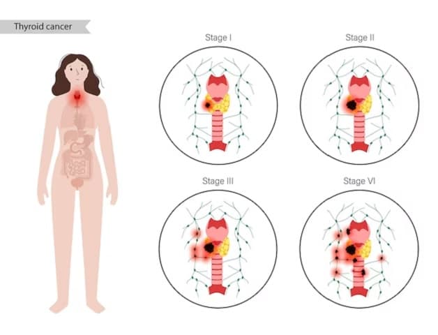 Cách điều trị bệnh ung thư tuyến giáp thể nhú