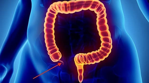 Viêm ruột thừa là bệnh thường gặp ở hệ tiêu hóa