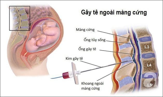 Gây tê ngoài màng cứng là kỹ thuật gây tê vùng phổ biến hầu hết các bà bầu sinh thường tự nhiên