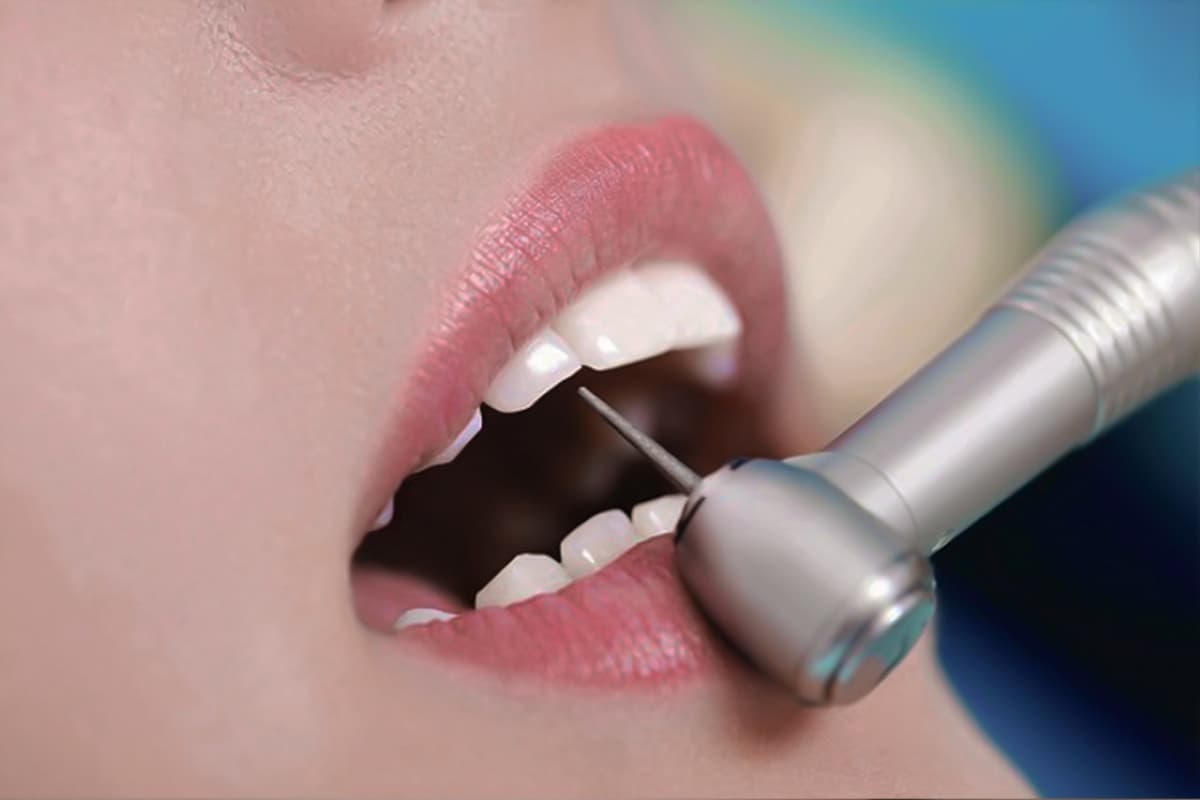 Có nên thực hiện mài nhỏ răng cửa không?
