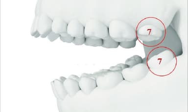 Có cần trồng lại nếu mất răng số 7 không?