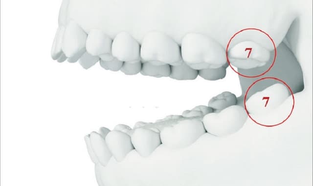 Có cần trồng lại nếu mất răng số 7 không?