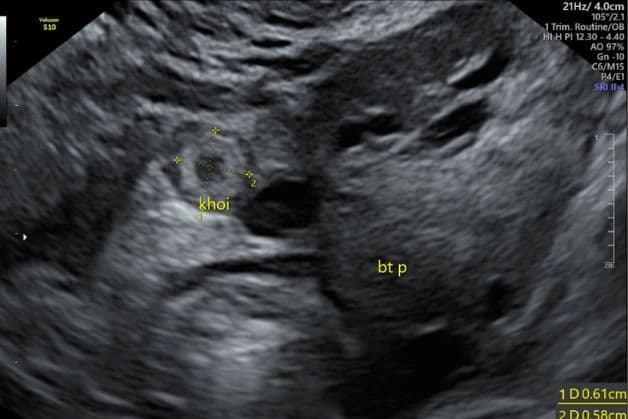 Nguyên nhân có thai ngoài dạ con thường gặp