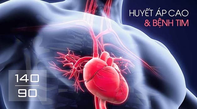 đột quỵ chảy máu não 