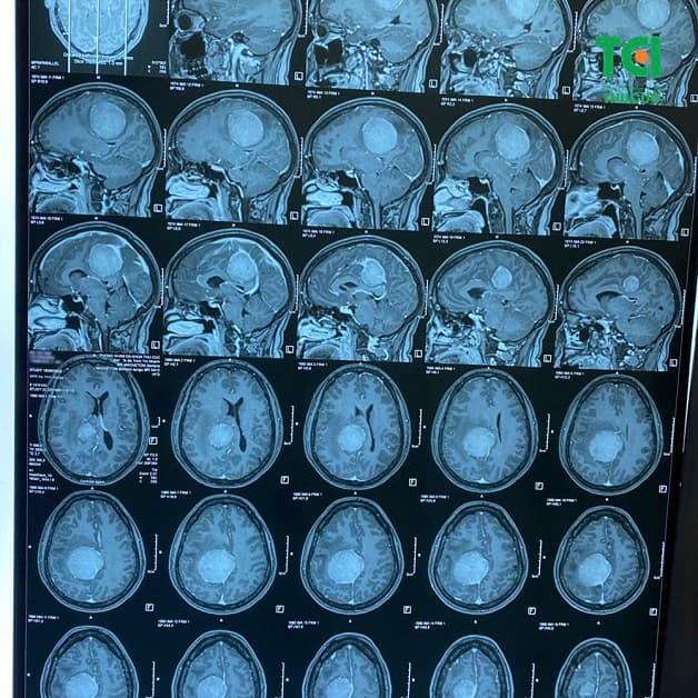 biến chứng của đột quỵ 