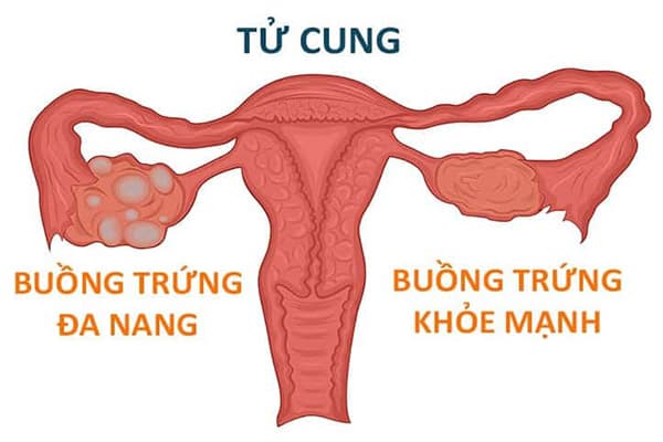 U nang buồng trứng có thể xuất hiện ở bất cứ ai, là nguyên nhân gây vô sinh hiếm muộn thường gặp