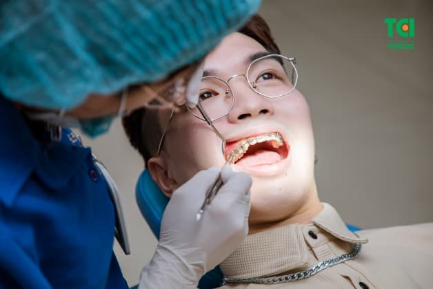 Niềng răng hỏng