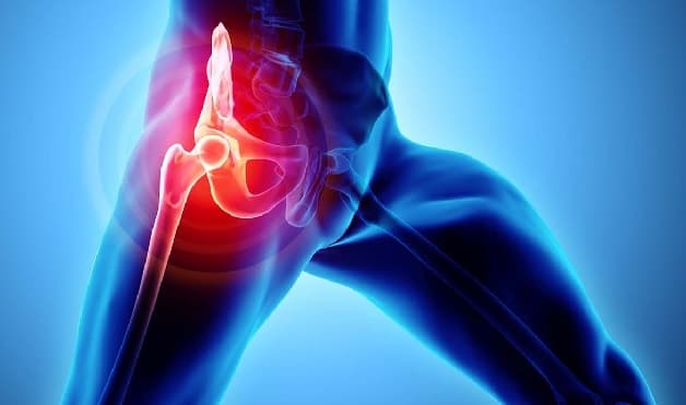 Thoái hóa khớp háng có thể xuất phát từ nhiều nguyên nhân khác nhau như chấn thương