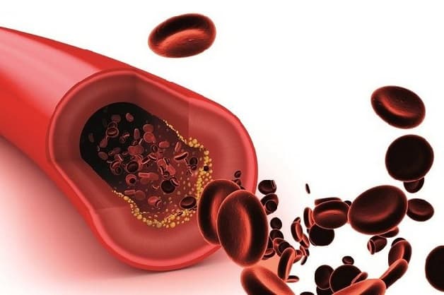 Thiếu máu cơ tim thầm lặng là tình trạng mạch máu cung cấp không đủ oxy và dưỡng chất cho cơ tim nhưng không có triệu chứng rõ ràng