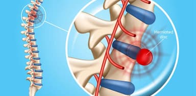 Nhận biết thoát vị đĩa đệm L4 L5 và cách điều trị
