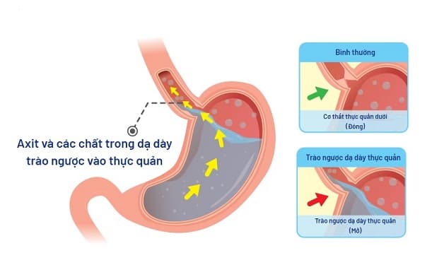 lý giải Trào ngược dạ dày có gây đau đầu không