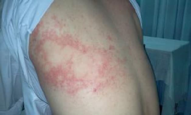 Triệu chứng của bệnh sán lá gan gồm đau bụng, dị ứng da