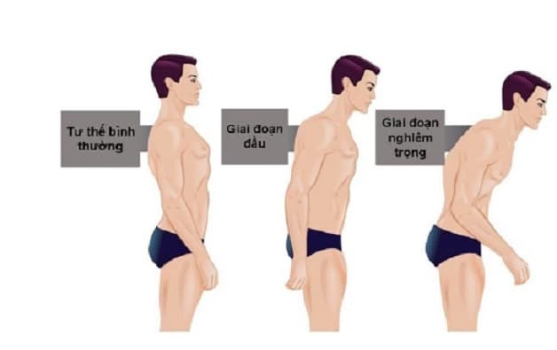 Triệu chứng thường gặp nhất ở người bệnh là đau cứng vùng hông hoặc lưng dưới