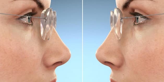 tròng kính cận mỏng cho người cận nặng