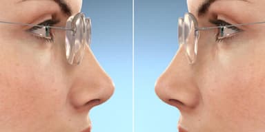 Lợi ích của tròng kính cận siêu mỏng có thể bạn chưa biết