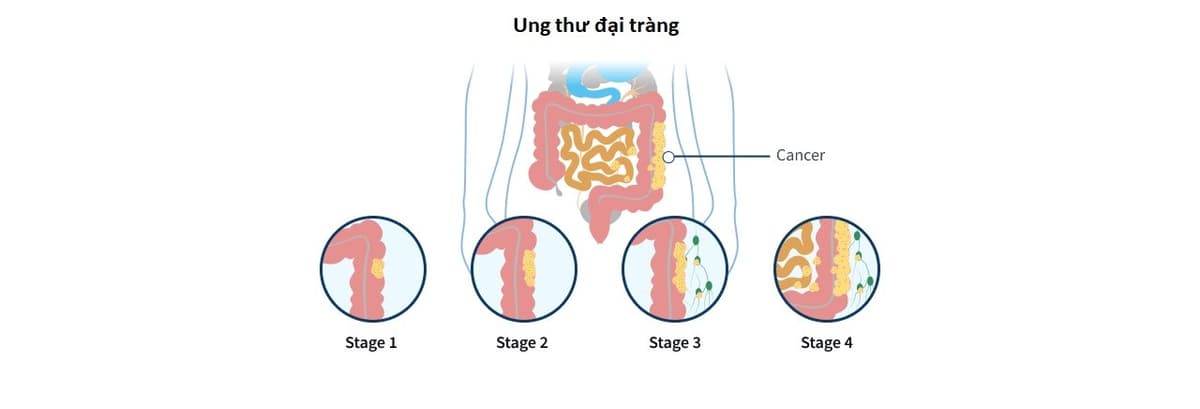 Dấu hiệu ung thư đại tràng giai đoạn 3 và cách điều trị