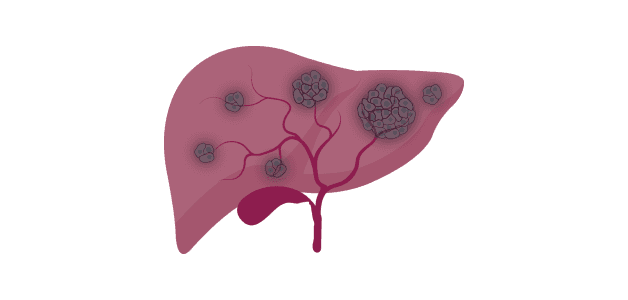 Các loại bệnh ung thư gan và cách phòng tránh