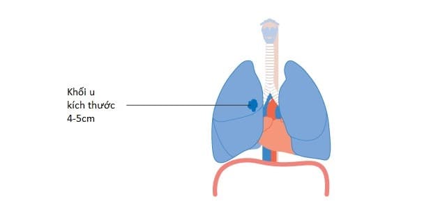 Điều trị bệnh ung thư phổi không tế bào nhỏ giai đoạn 2