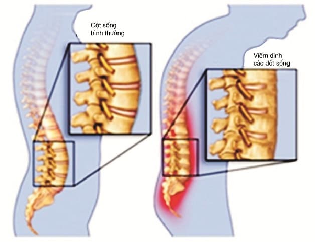 Viêm cột sống dính khớp xuất phát từ yếu tố di truyền và môi trường