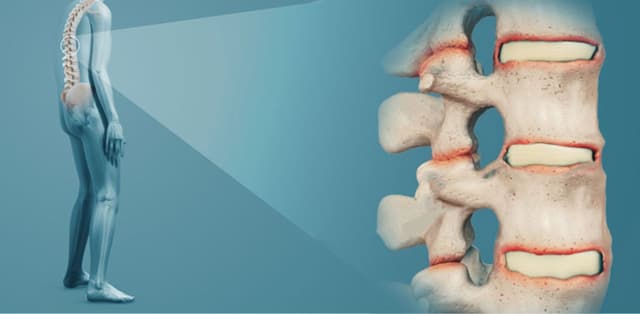 Thông tin cần biết về bệnh viêm dính khớp cột sống