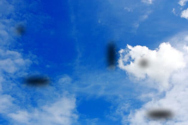 Bệnh nhân VMBĐ có thể sẽ thấy nhiều bóng đen trôi lập lờ trước mắt như ruồi, muỗi bay.