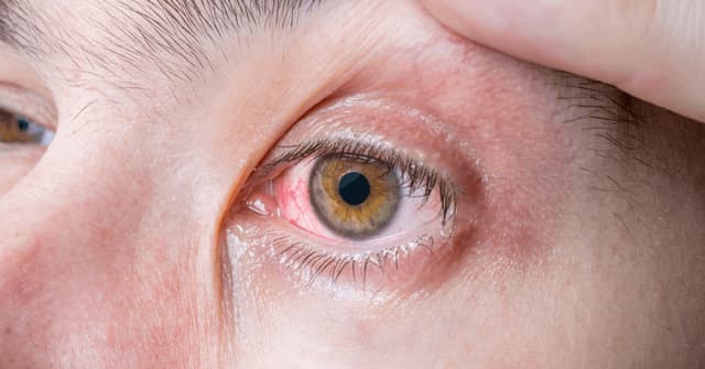 Từ A đến Z về viêm màng bồ đào mắt