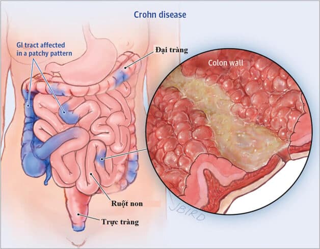 Bệnh viêm ruột Crohn có thể gây ra viêm đại tràng