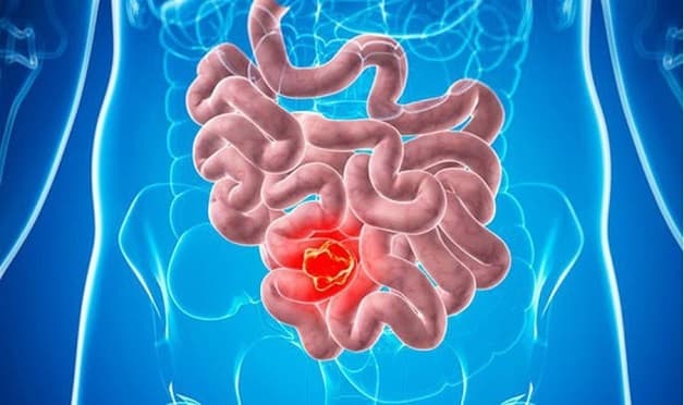 Viêm ruột có thể gây ra nhiều biến chứng nguy hiểm