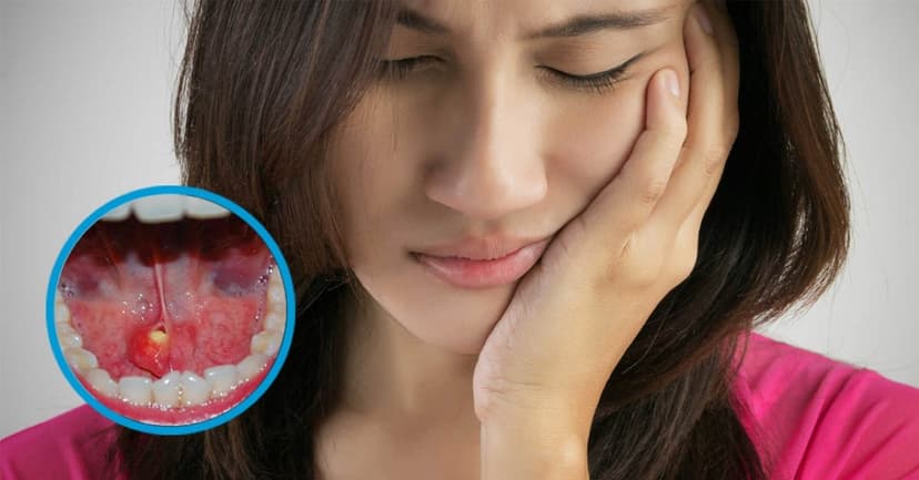 Những điều cần biết về vôi hóa tuyến nước bọt