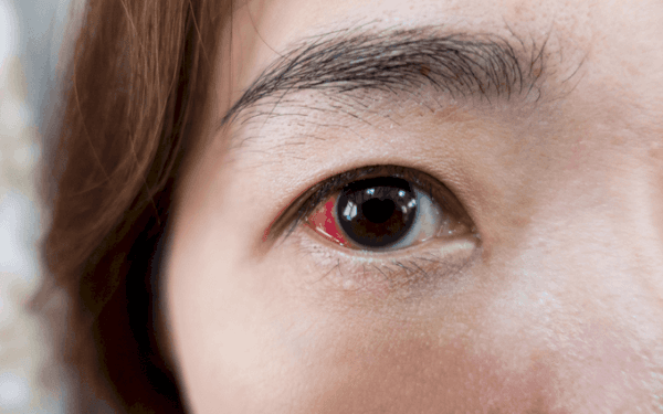 Ở mắt, bệnh đái tháo đường gây tổn thương các mao mạch võng mạc. 